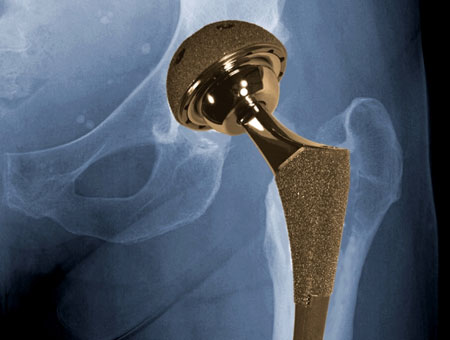 Patients with metal-on-metal implants require systematic follow-up