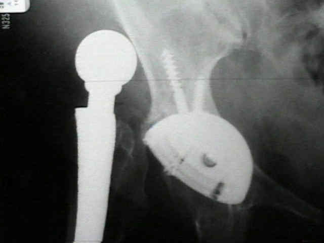The management of an unstable hip can chal- lenge the most experienced orthopaedic surgeon. 